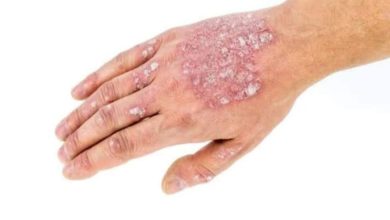 صورة الصدفية وأعراضهاوأنواعها وكيفية علاجها Psoriasis
