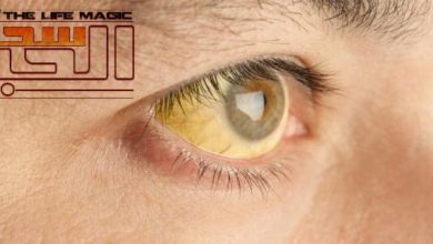 صورة اليرقان لدى البالغين (Jaundice) ما هي المسببات