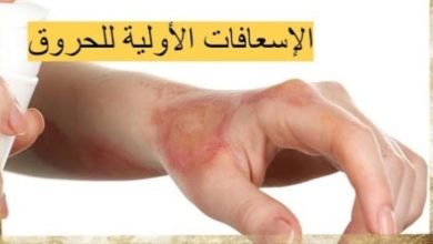 صورة أنواع الحروق والإسعافات الأولية لكل منها