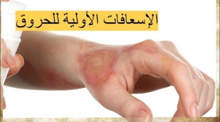 أنواع الحروق والإسعافات الأولية لكل منها