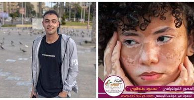 صورة محمود أشرف طنطاوي عمل على اظهار الجانب الجمالي من البهاق