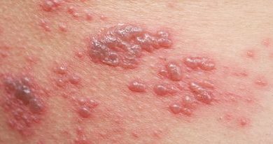 صورة الوقاية خير من قنطار علاج …مرض الزونا ما هو أعراضه وعلاجه