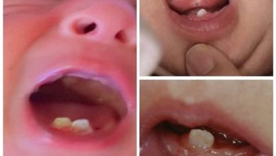 صورة الأسنان الولادية natal teeth مضاعفاتها وعلاجها