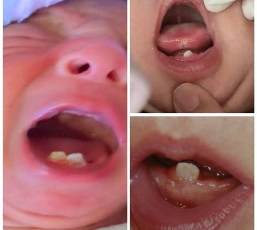 الأسنان الولادية natal teeth مضاعفاتها وعلاجها